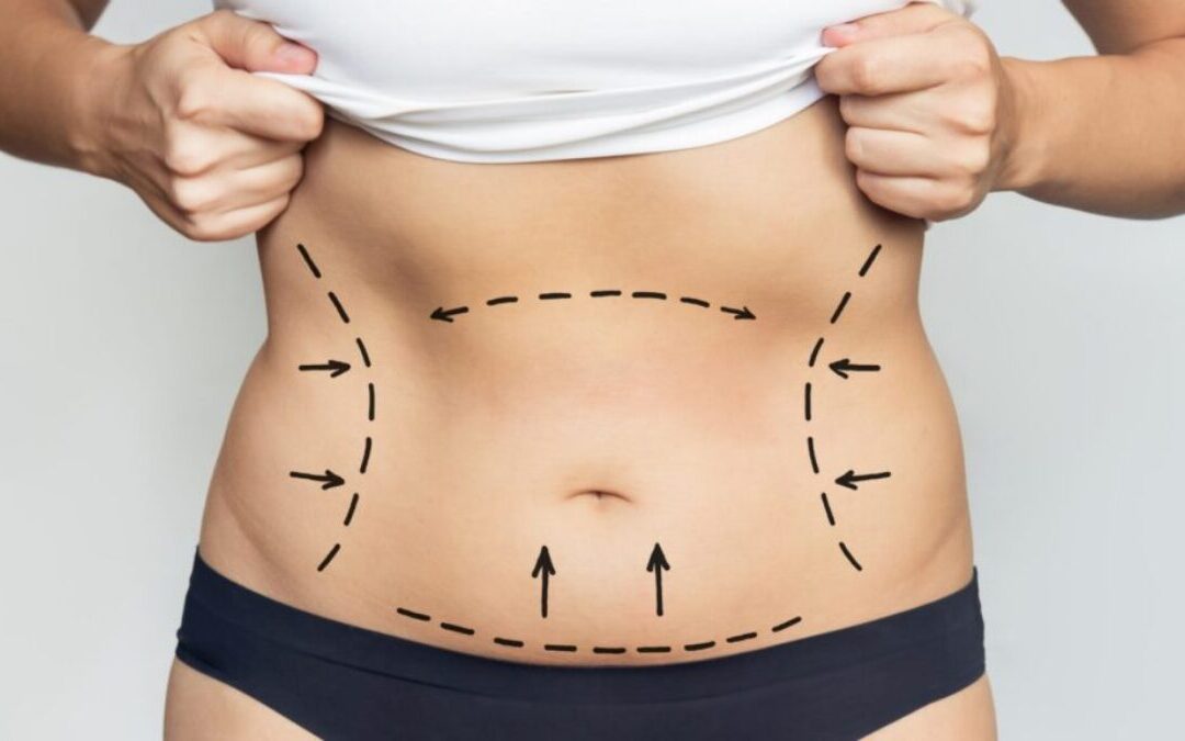 Liposuction Surgery in Dubai