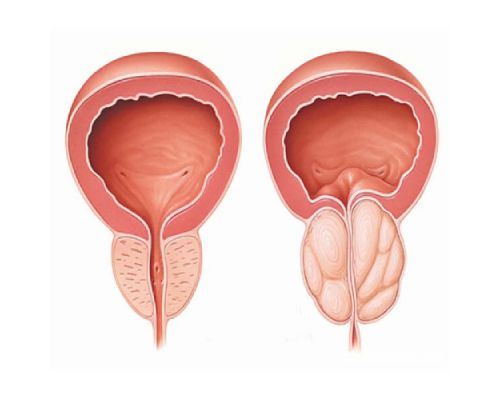 Enlarged Prostate Specialists: Diagnosis, Treatment, and Finding the Right Doctor