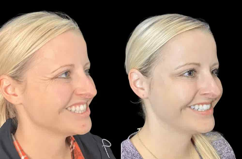 Best Doctors in Dubai for Botox Offering Personalized Care