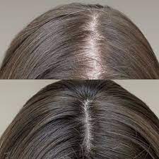 White Hair Removal in Dubai-Abu Dhabi