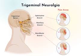 What Are the Treatments for Trigeminal Neuralgia Relief?