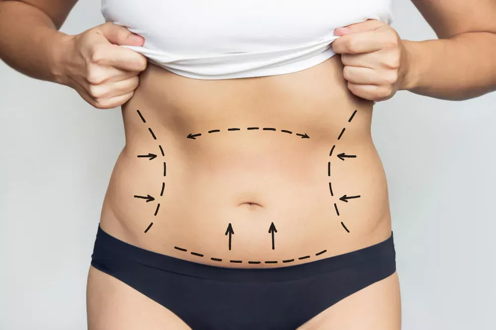 Liposuction A Comprehensive Guide To Fat Reduction