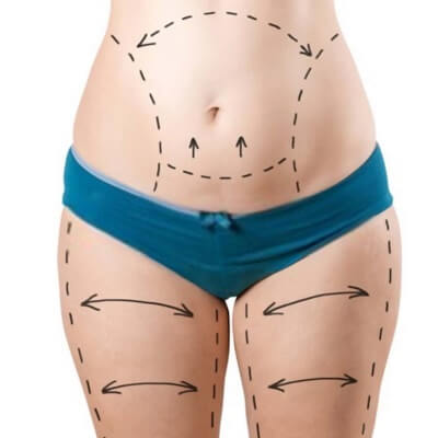 Tummy Tuck Surgery (Abdominoplasty) Dubai, Abu Dhabi