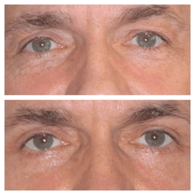 Best Eye bag removal Surgeons in dubai: What You Need to Know About Scarring