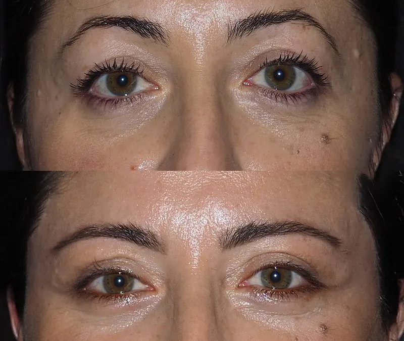 Understanding pigmentation vs Eye bag removal in Dubai