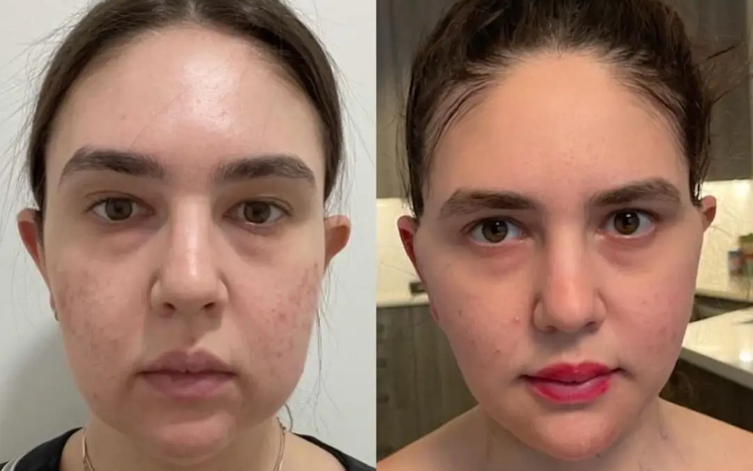 How to Speed Up Healing After Buccal fat removal in Dubai