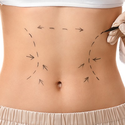 Can Laser Lipo in Dubai Target Stubborn Body Fat