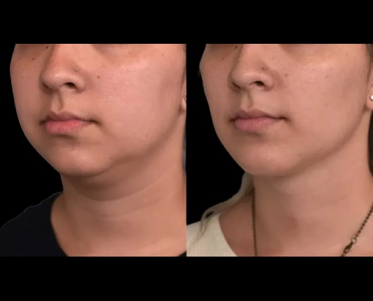 Can You Get Double chin removal in Dubai While Traveling?