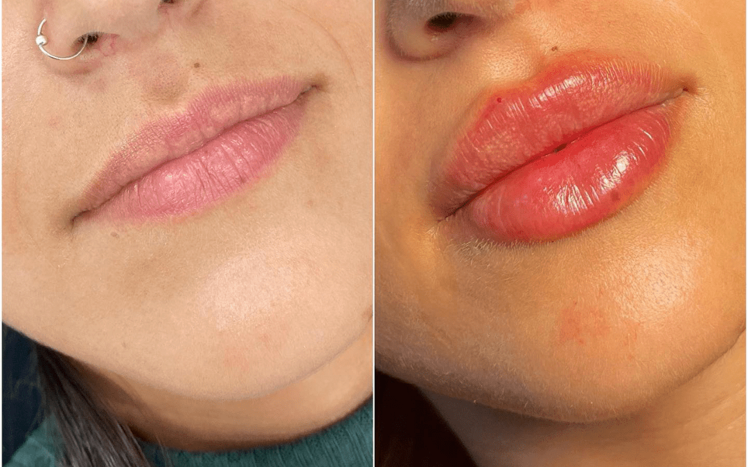 Juvederm for Subtle Facial Contouring: Achieve Your Ideal Look at the Best Aesthetic Clinic in dubai