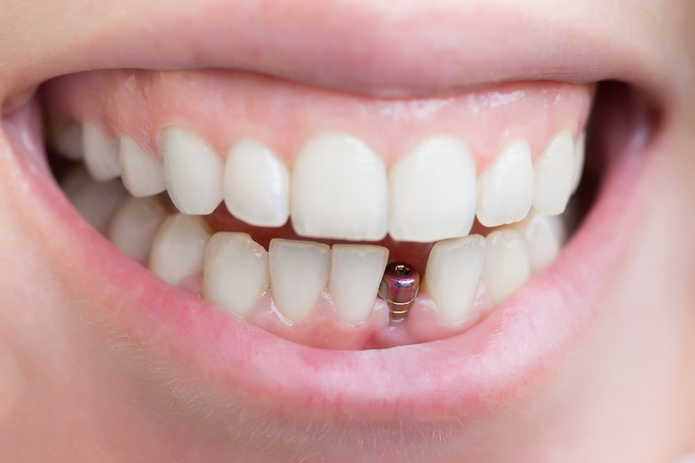 Dental Implants in Dubai for Diabetes and Chronic Issues
