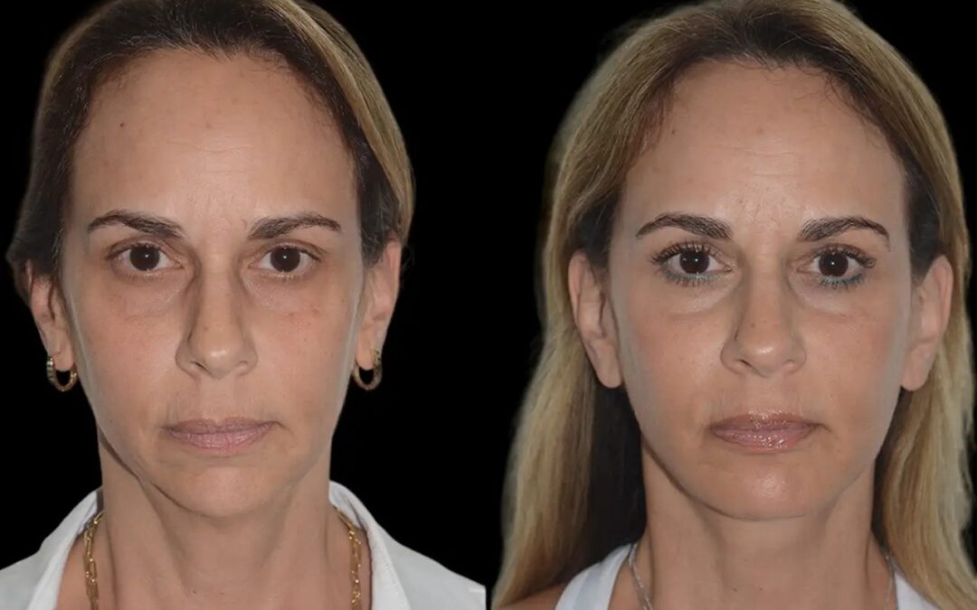 Best Doctors in dubai for Chin Fillers: Sculpt Your Jawline with Precision