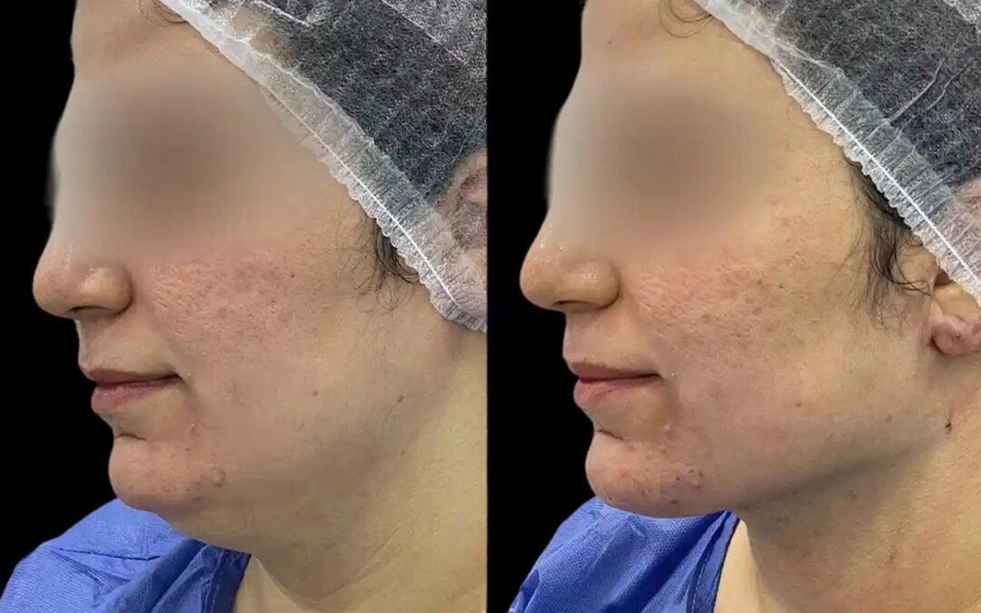 The Importance of Choosing the Best Doctors in dubai for Chin Fillers