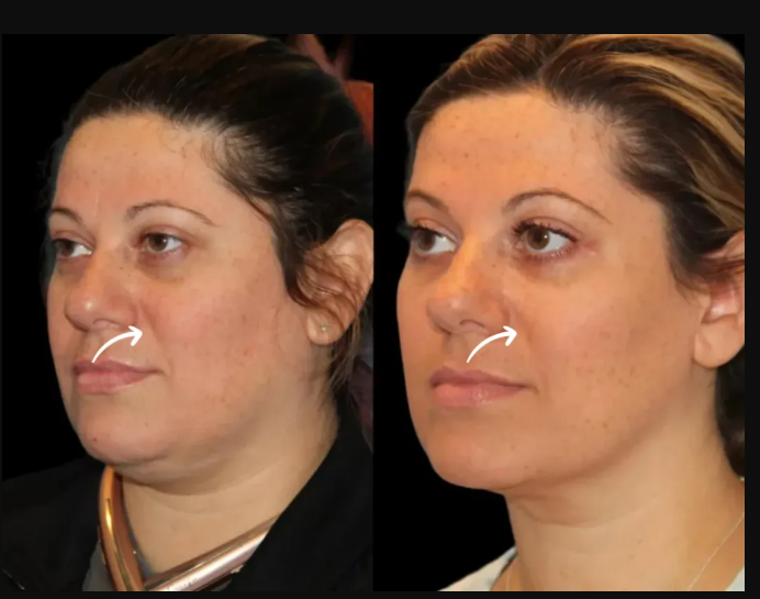 The Holistic Approach to Sculptra Fillers by Dubai’s Best Plastic Surgeon