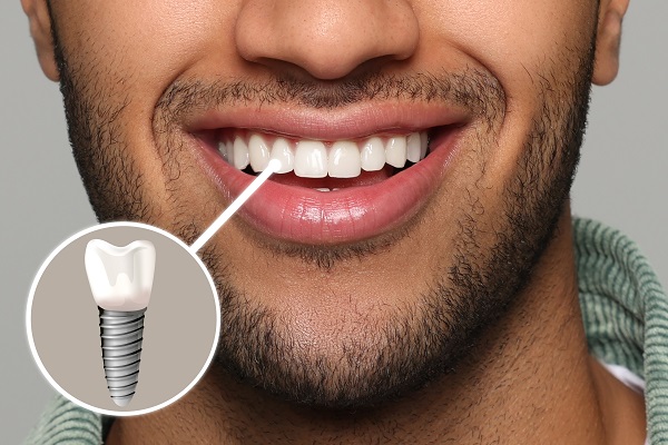 What Should I Do If My Dental Implant Feels Loose in Dubai