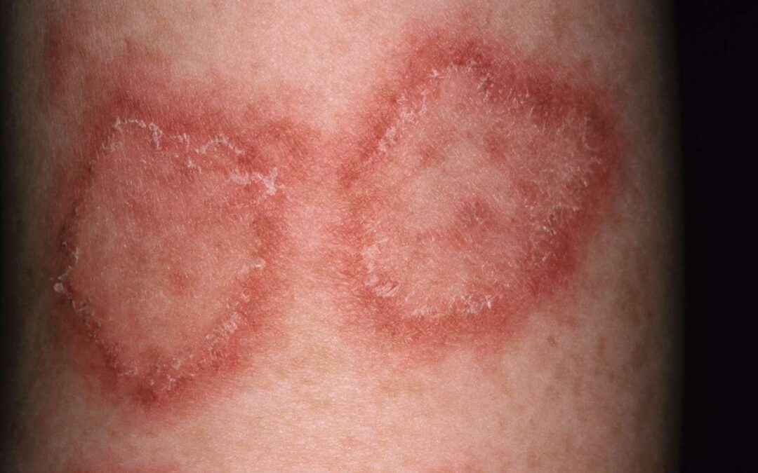 Why Are Skin Allergies So Common in Dubai’s Climate