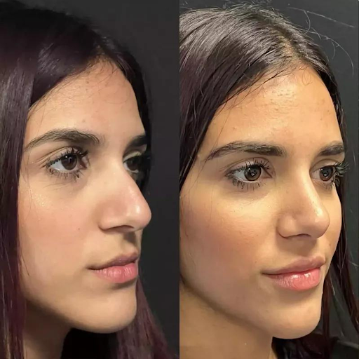 Best Rhinoplasty Surgeon in Dubai: Avoid Common Mistakes