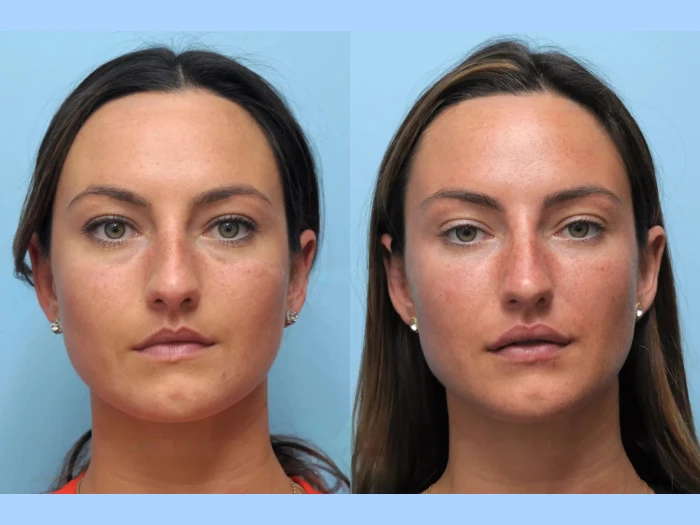 Safe and Effective Thread Lift by the Best Plastic Surgeon in Dubai