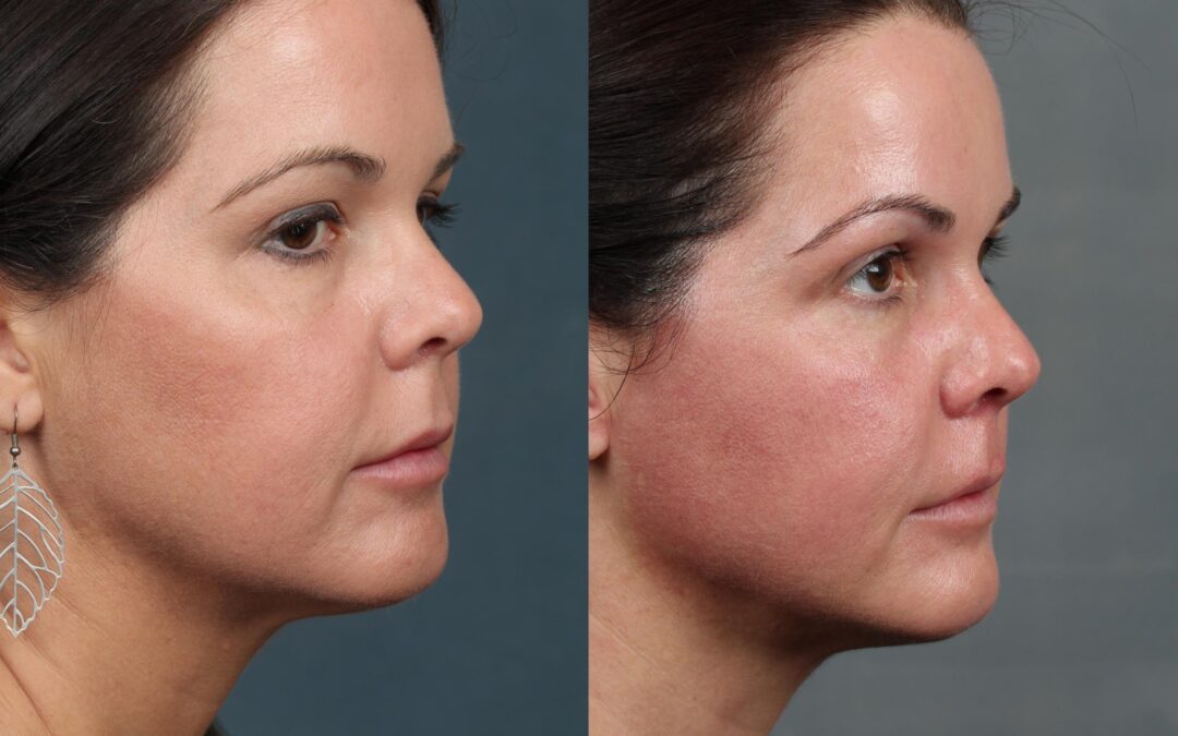 non surgical