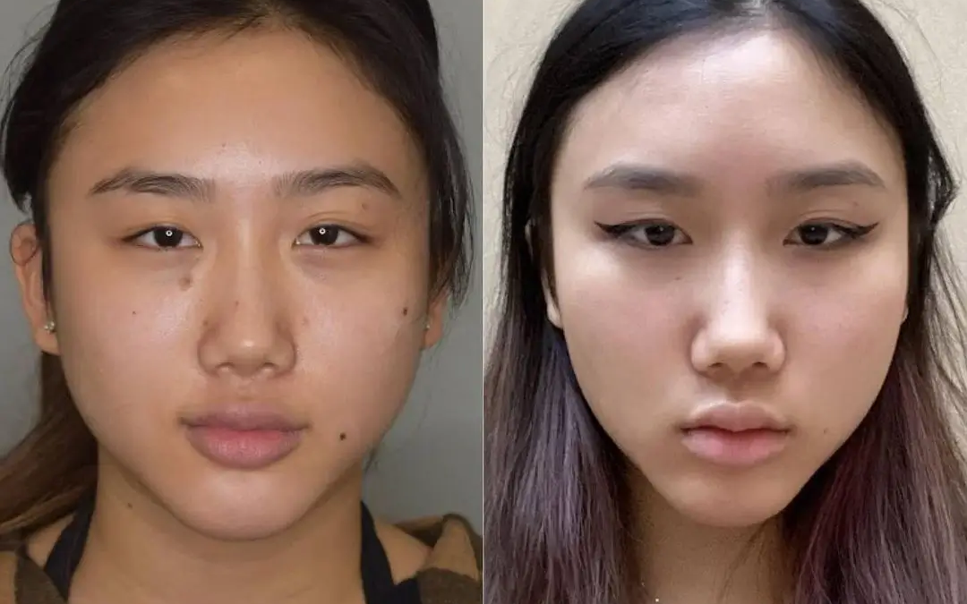 Buccal Fat Removal