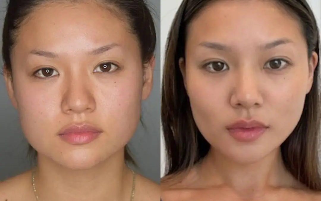 Best Doctors in Dubai Share the Latest Trends in Buccal Fat Removal