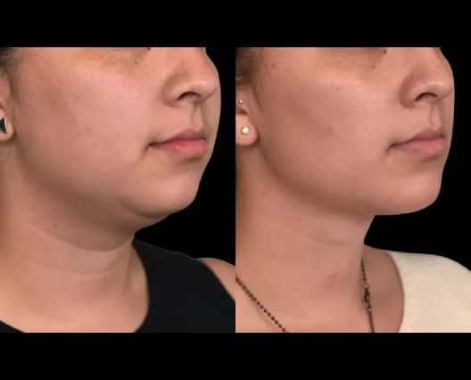 How to Enhance Double Chin Removal Results with a Healthy Lifestyle: Insights from the Best Doctors in Dubai