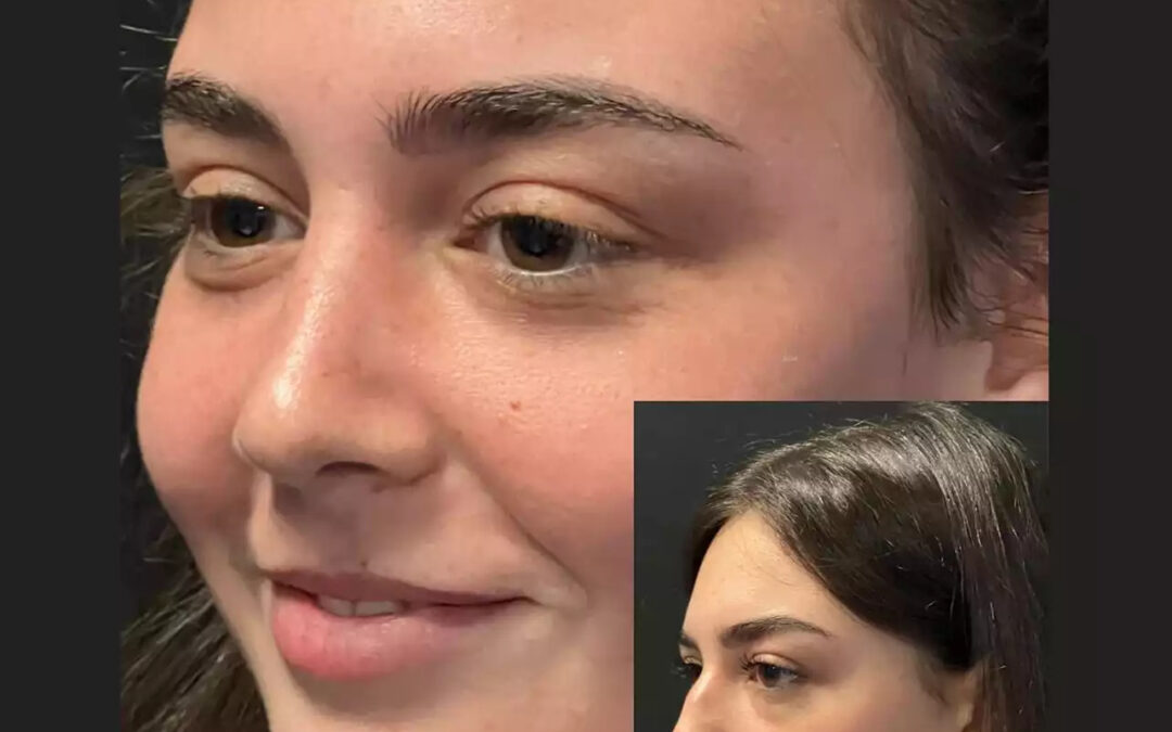 Real Results: Before & After Rhinoplasty by the Best Doctors in Dubai