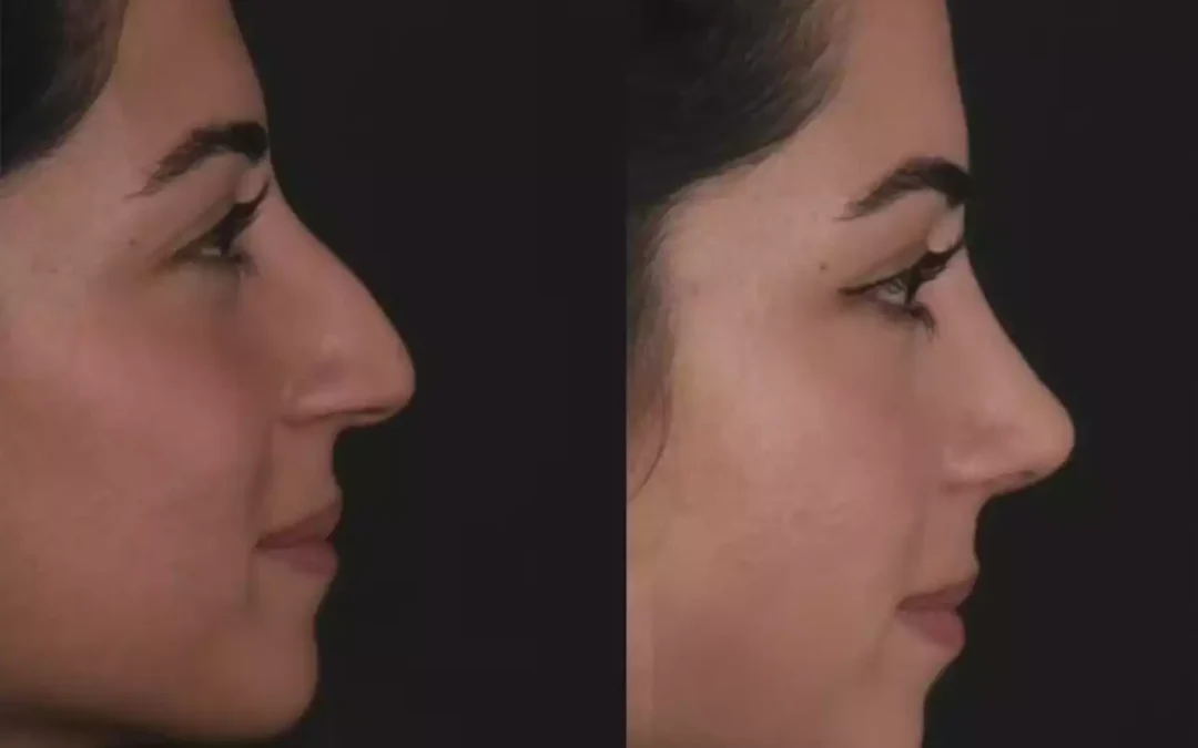 Recovery Tips from the Best Doctors in Dubai After Septoplasty