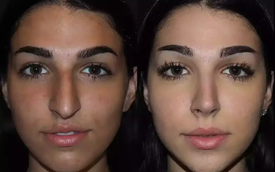 best rhinoplasty surgeon in dubai