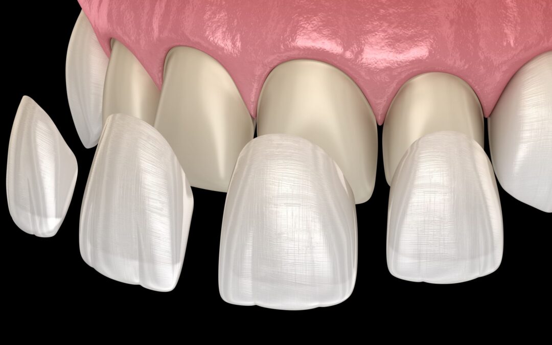 What to Do If Your Veneer Chips or Falls Off in Dubai?