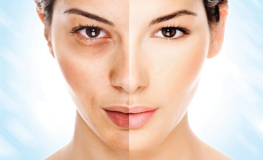 Can Melasma Be Treated Safely During Pregnancy in Dubai’s Climate?