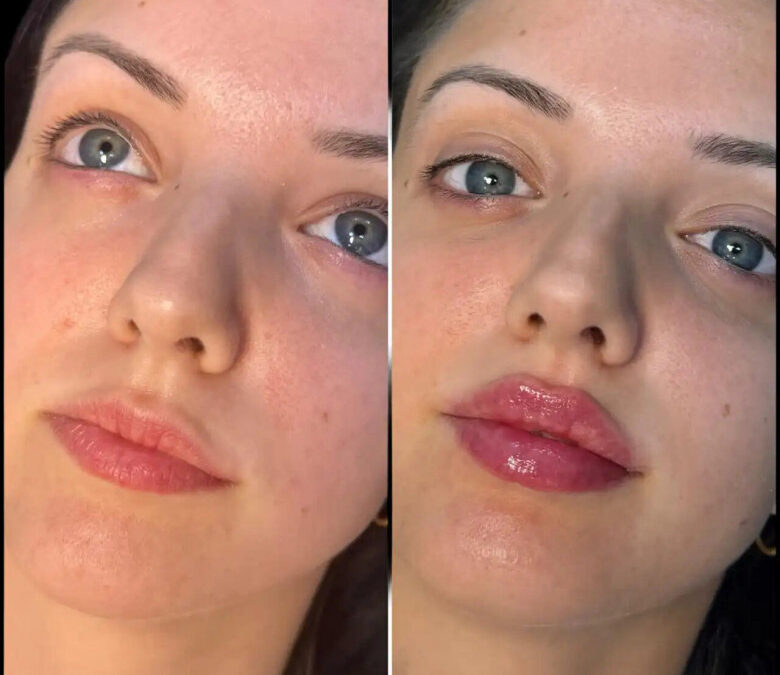 Top Reasons Why the Best Aesthetic Clinic in Dubai is Your Go-To for Fillers